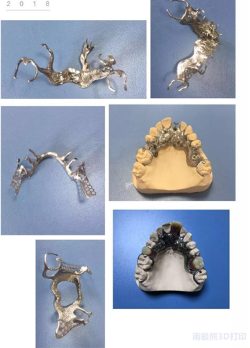 瑞博医疗率先将金属增材制造技术应用于定制式义齿的生产加工和制作的